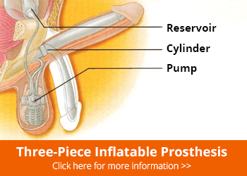 three-piece-inflatable-prosthesis

