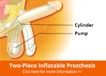 two-piece-inflatable-prosthesis

